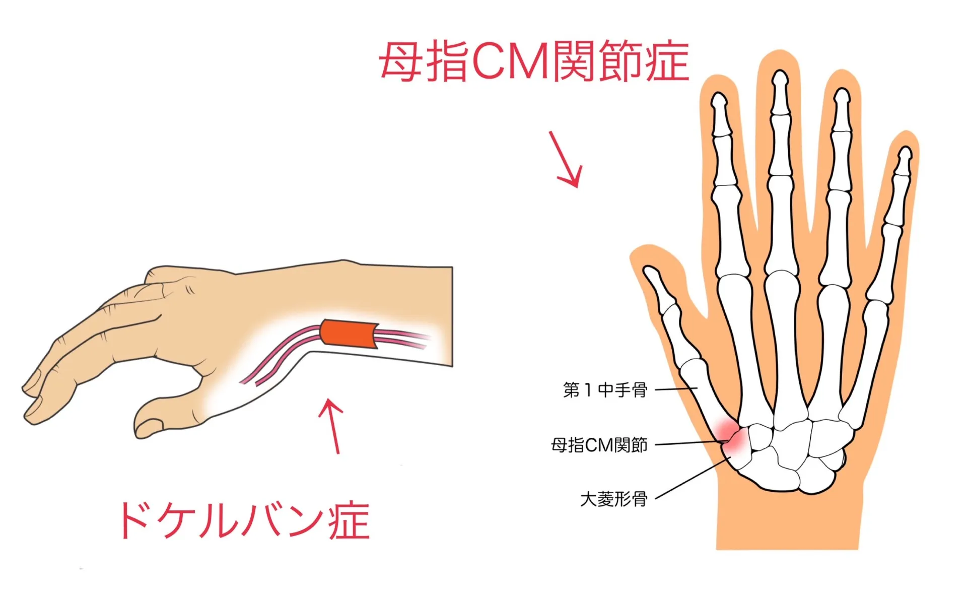 親指の付け根が痛い原因は?日常動作から見直すセルフケア